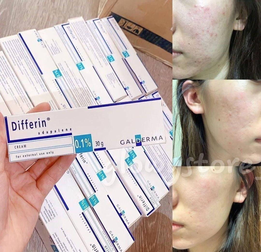 Differin crem,Gаlderma,Differin gel (Дифферин гель) Adapalene 0.1%(Адапален)15\30 g.Франция
Differin crem,Gаlderma,Differin gel (Дифферин гель) Adapalene 0.1%(Адапален)15\30 g.Франция