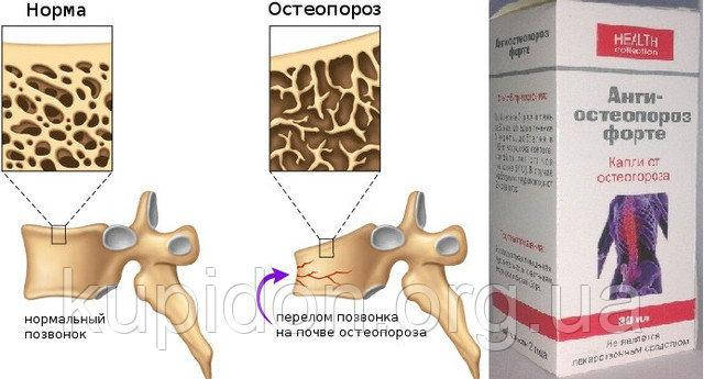 Анти-остеопороз Форте капли от остеопороза суставов, от артита, артроза, остеохондроза, ревматизма, полиартрит
Анти-остеопороз Форте капли от остеопороза суставов, от артита, артроза, остеохондроза, ревматизма, полиартрит