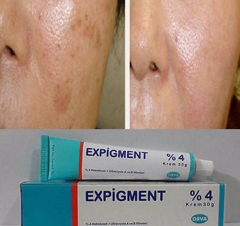 

Экспигмент Expigment отбеливающий крем от пигментных пятен 4%