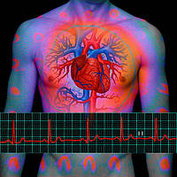 Інфаркт міокарда, реабілітація, атеросклероз, холестерин, для серця, судин Колоїдні фітофорули Арго