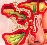 Спрей у разі гаймориту Вековий Схід, фото 5