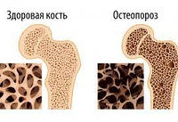 Кістки / Остеопороз / Суглоби