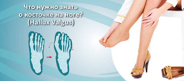 Що потрібно знати про кісточці на нозі (HALLUX VALGUS)!