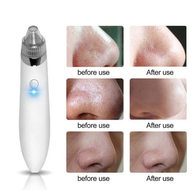 Вакуумный очиститель от угрей, комедонов, акне Spot Acne cleaner JB-8620