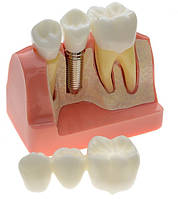 Демонстрационная модель имплант с мостом