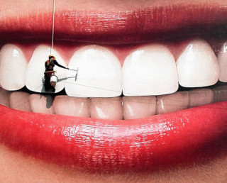 відбілювання зубів