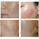 5=6 Набір масок від акне і запалення Bioaqua Pure Skin Acne Rejuvenation Moisturising Mask, фото 3