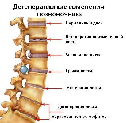 Дегенеративні зміни хребта. Картинка 6.