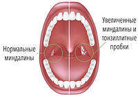 Лечение хронического тонзиллита