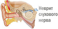 Застосування лікувальної грязі для лікування невриту слухового нерва.
