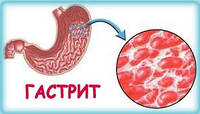 Лікування гастриту