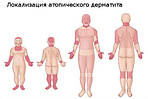 Лікування атопічного дерматиту