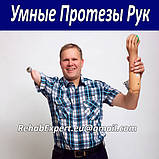 Протезування кінцівок, фото 3