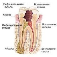 Депульпування зуба