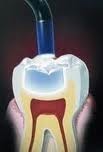 Пломбування зубів