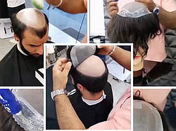 Система заміщення волосся для чоловіків. Накладка на лісину (у разі облисіння) з натурального волосся на клею
