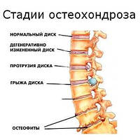 Що таке остеохондроз і як його лікувати?