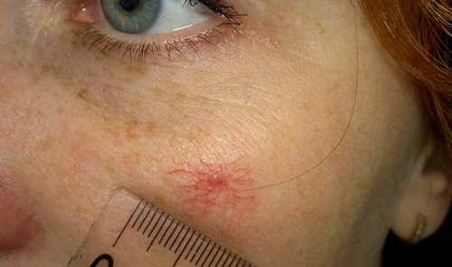 Лазерне видалення судин, фото 1