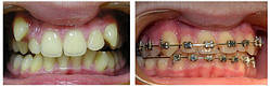 Ортодонтичне лікування знімними апаратами 