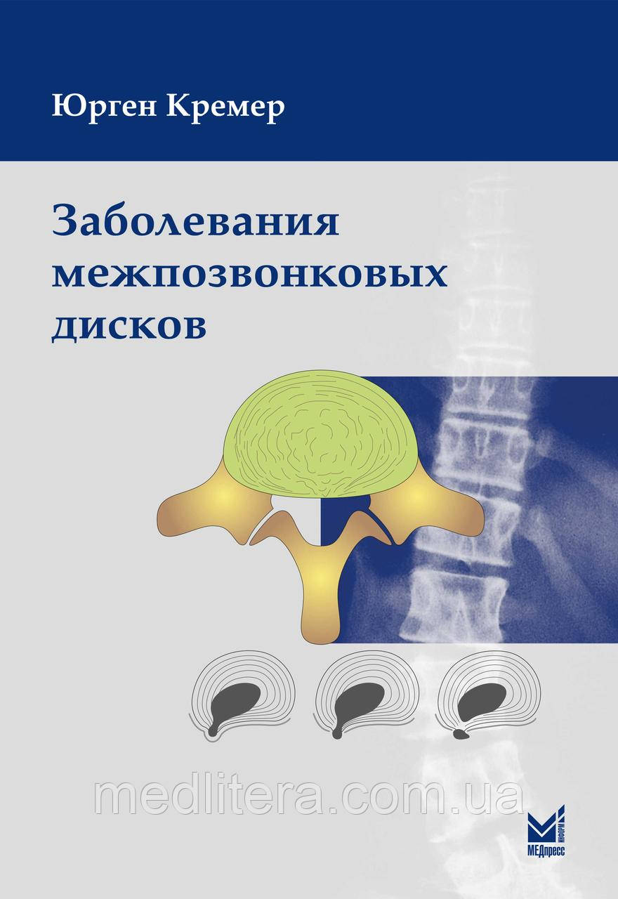 Кремер Ю. Заболевания межпозвонковых дисков пер с англ Широкова 2-е издание 2015 год