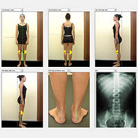 Система відеографії 2D для діагностики постави тіла та ходи
