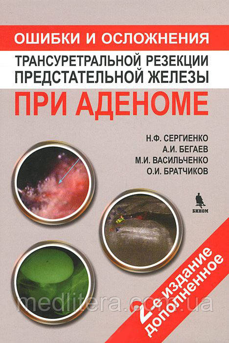 Микола Сергієнко Помилки та ускладнення трансуретральной резекції передміхурової залози при аденомі