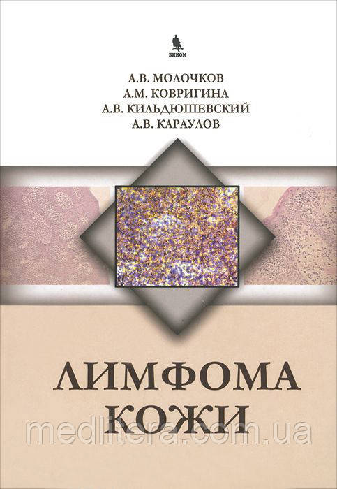 А. Молочков, А. Ковригіна, А. Кильдюшевский, А. Караулів Лімфома шкіри
