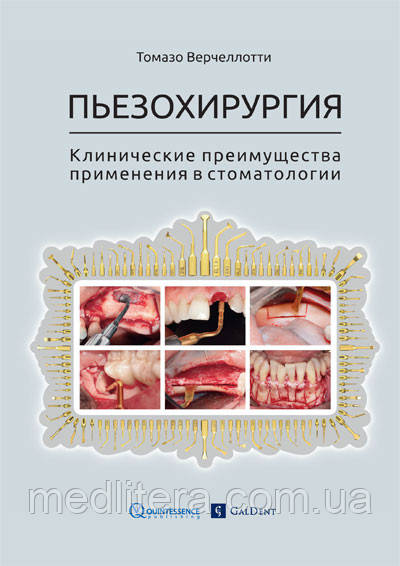Верчеллотти Т. П'єзохірургія. Клінічні переваги застосування в стоматології.