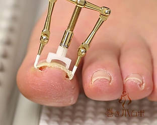 Пристрій для корекції та корекції врослого нігтя.