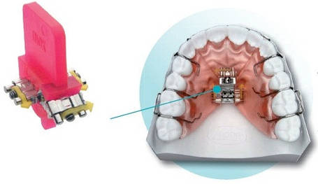 Гвинти ортодонтичні