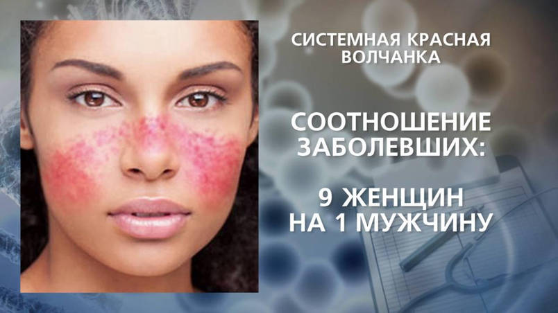 Системна Червона Вовчанка, симптоми і лікування БАД НСП.
