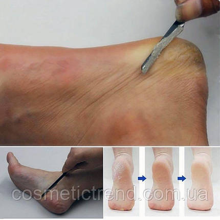 Інструмент для видалення огрубілої шкіри (педикюрний ніж, гострий ніж-лез для педикюру), фото 1