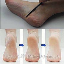 Інструмент для видалення огрубілої шкіри (педикюрний ніж, гострий ніж-лез для педикюру), фото 3