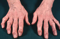 Що таке вузлики Гебердена і як від них позбутися?