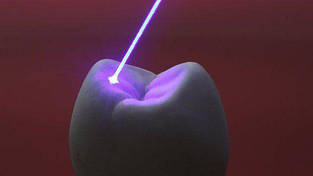 Dental Laser