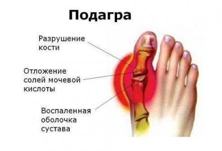 Подагра, причини захворювання, попередження і профілактика.
