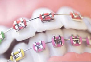 Ортодонтичні матеріали