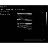 Ультразвуковий апарат EMP, фото 2