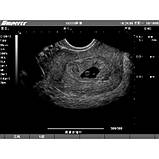 Ультразвуковий апарат EMP, фото 4