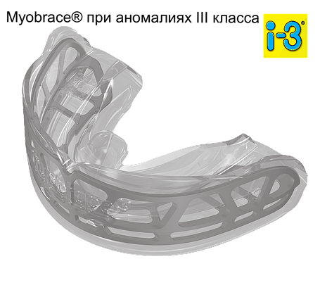 Трейнер Myobrace при аномаліях III класу I-3 large, фото 1