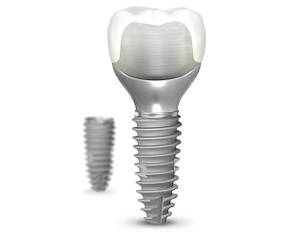 ДЕНТАЛЬНА ІМПЛАНТАЦІЯ