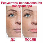 Дермароллер DRS 12, 300, 750 і 1200 титанових голок 0,25/0,3 мм, фото 7