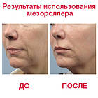 Мезороллер DRS 180, 600 і 1200 титанових голок 0,25 мм, фото 6