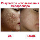 Дермароллер DRS 12, 300, 750 і 1200 титанових голок 0,25/0,3 мм, фото 8