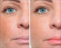 Мезоролер професійний Derma Roller на 2 мм, 540 голок, фото 6