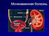Сечокам'яна хвороба (мутрашмари) з точки зору Аюрведи.
