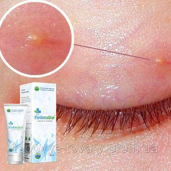 papilloma stop krém papilloma ajkak száj