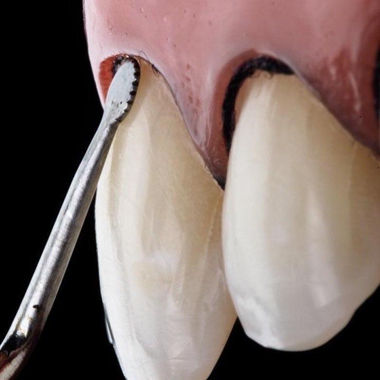 Пакер в стоматологии. Статьи компании «Dental Group»