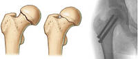 Переломи шийки стегнової кістки (переломи "шийки стегна")