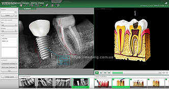 Програма для візіографів Vatech EzDent-i - Повна Версія 2025 - Підтримка WINDOWS 11 - блок консультації - вбудована база імплантів